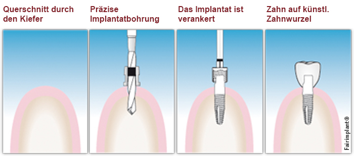 Vorgehen Implantate